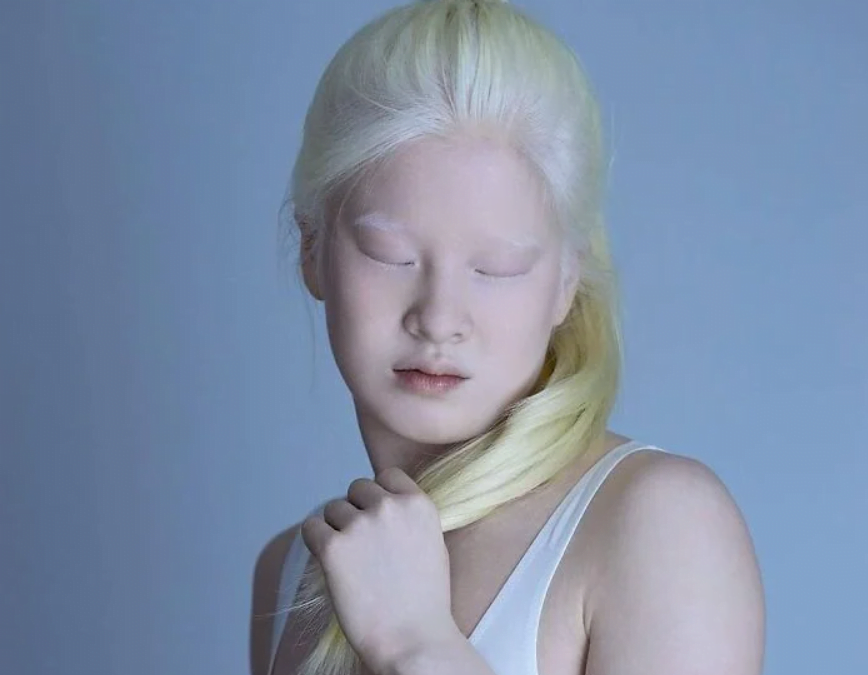 Γεννήθηκε με αλμπινισμό, εγκαταλείφθηκε όταν ήταν μωρό και σήμερα είναι κορυφαίο μοντέλο της Vogue